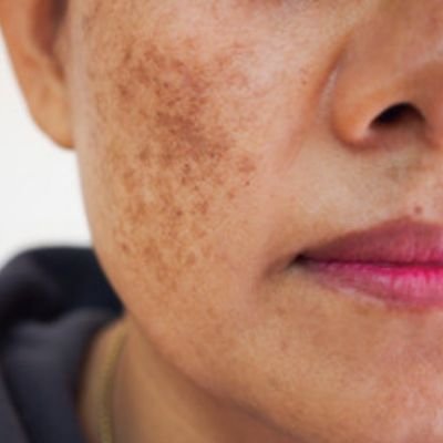 melasma